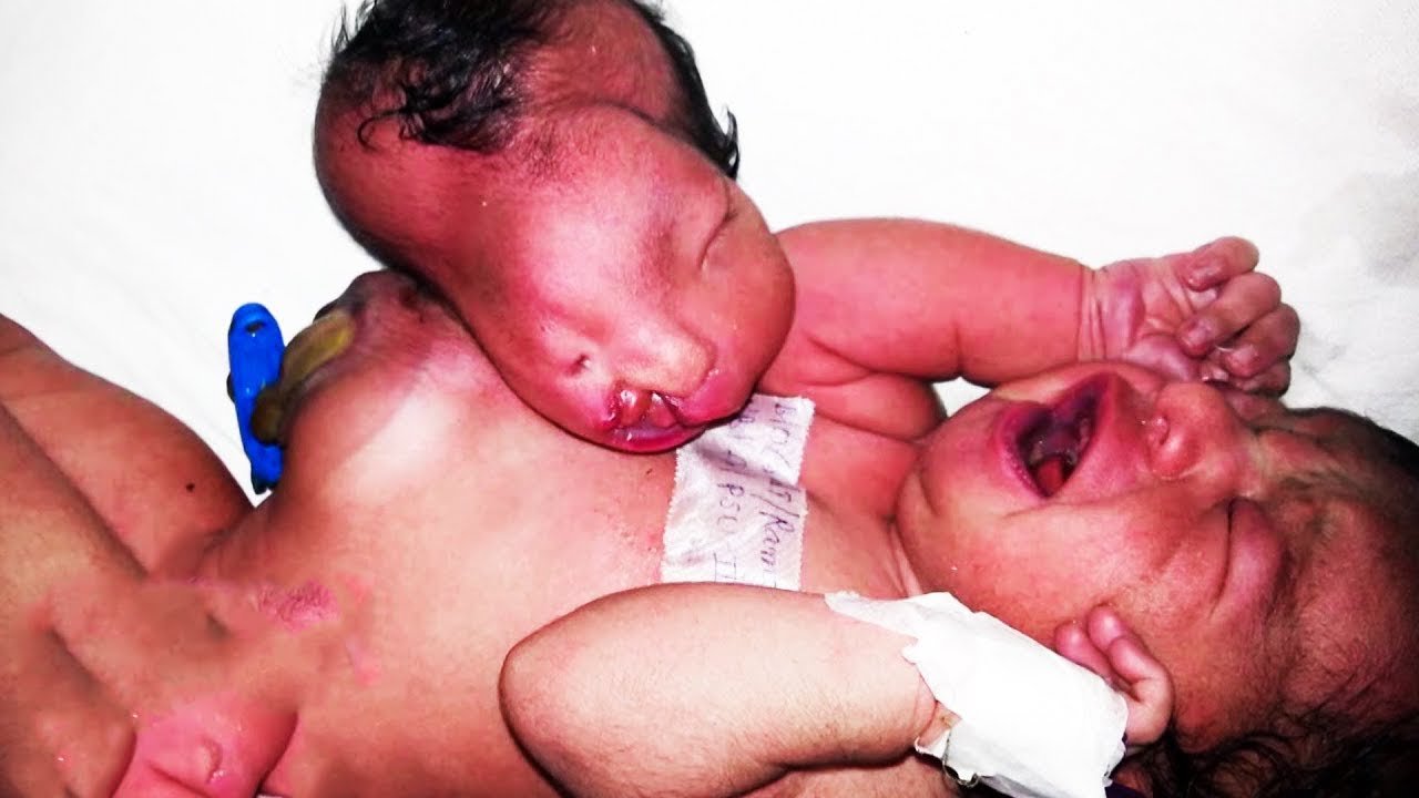 This Woman Was Expecting Rare Triplets  But When Doctors Saw Her Placenta, They Feared The Worst