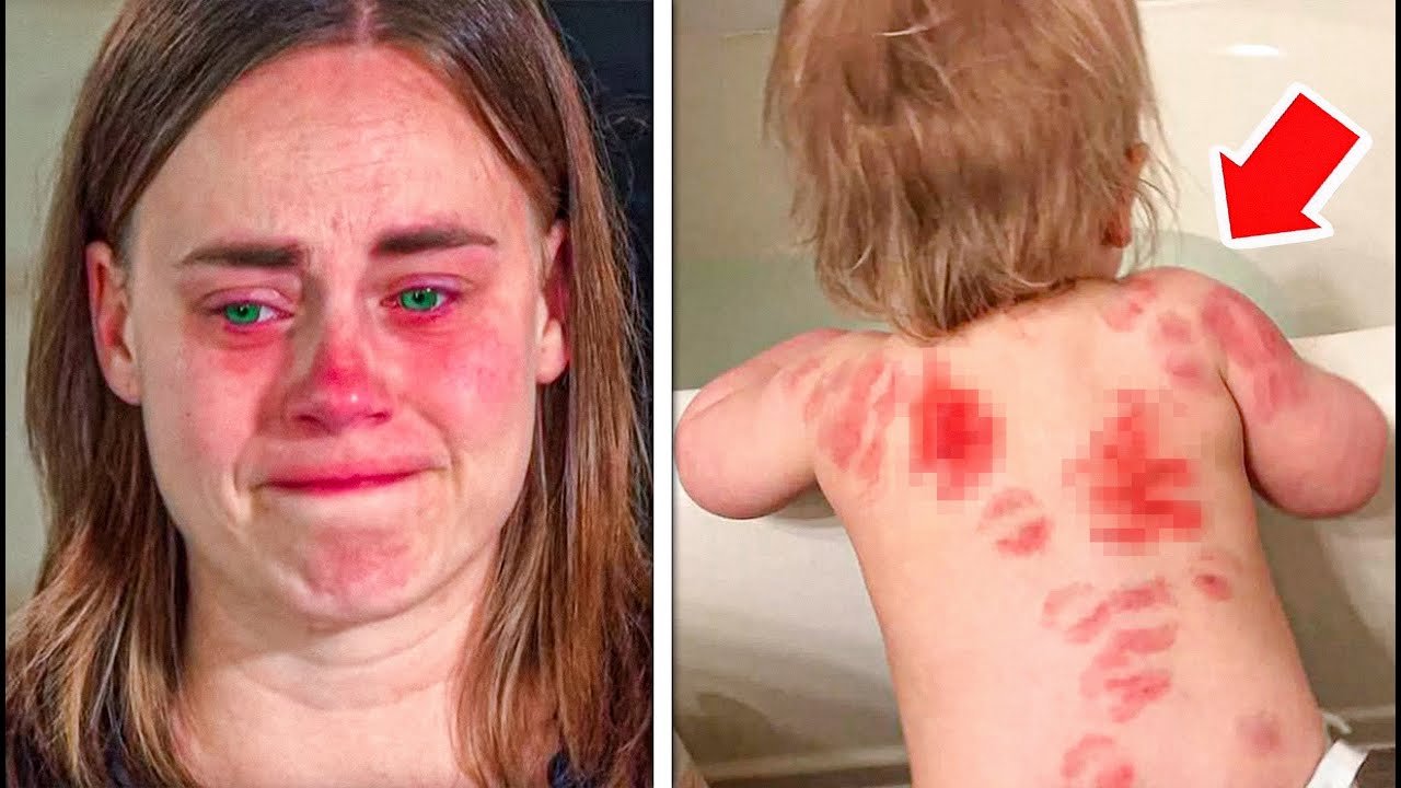 Mom Ignores Pimple on Son’s Back, What Happens Next Is Shocking