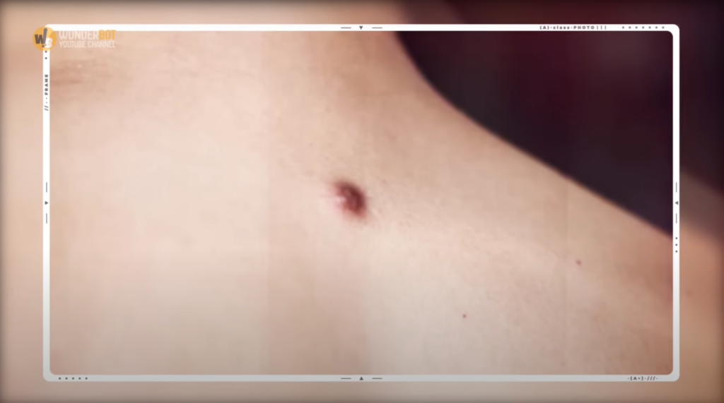 Mom Ignores Pimple on Son’s Back, What Happens Next Is Shocking